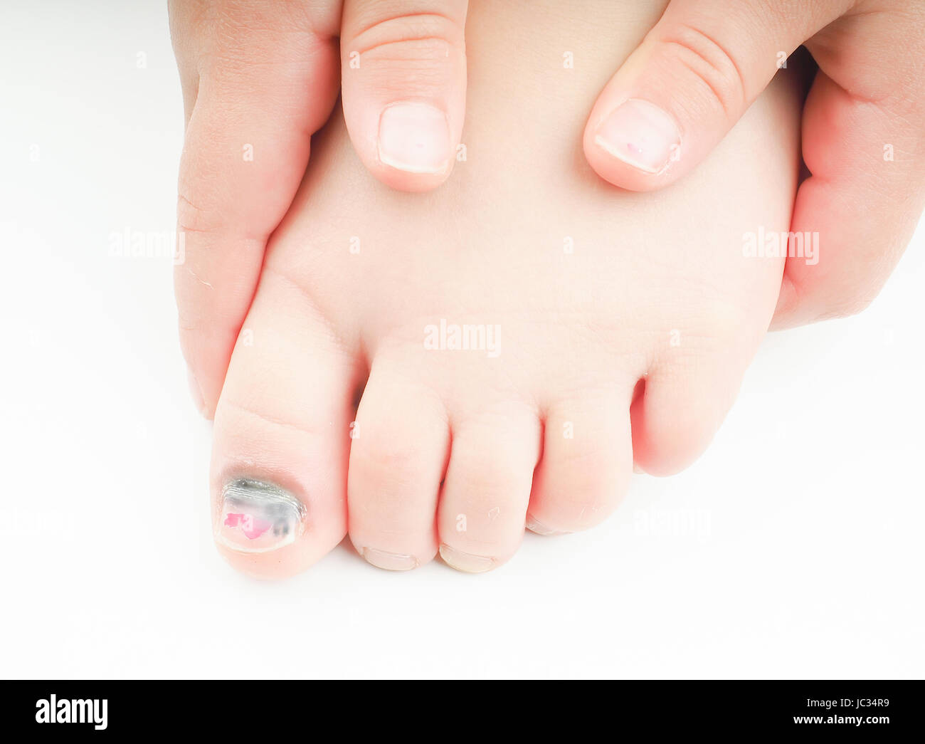 Kleine Mädchen auf ihren Fuß mit einem verletzten Großzehe halten zeigt blauen Nagel auf der Hallux mit ein klein wenig rosa Pediküre links Stockfoto