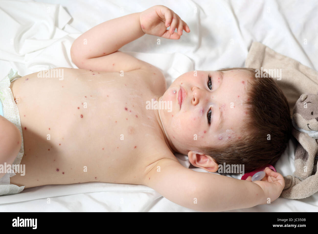 Details eines Babys im Alter von 20 Monate alt, er hat Windpocken. Stockfoto