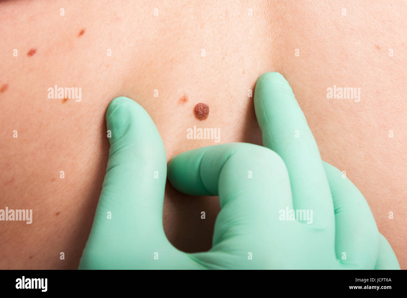 Hautarzt Hand Inspektion Haut Maulwurf als epidermale Krebs verdächtige Konzept Stockfoto