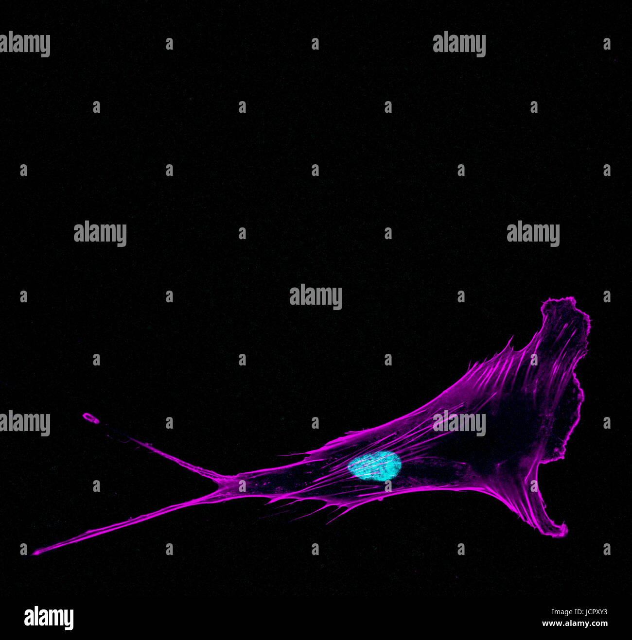 Immunfluoreszenz konfokale Abbildung von einer eindringenden metastasierendem Prostatakrebs Einzelzelle ragen Vorsprünge mit Zellskelett in violett und nucl Stockfoto