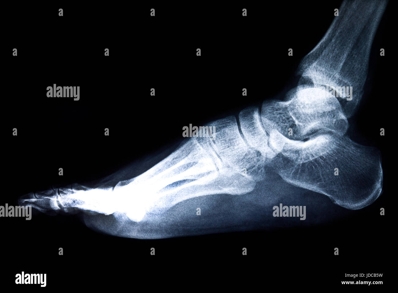 Foot Xray Stockfotos & Foot Xray Bilder - Alamy