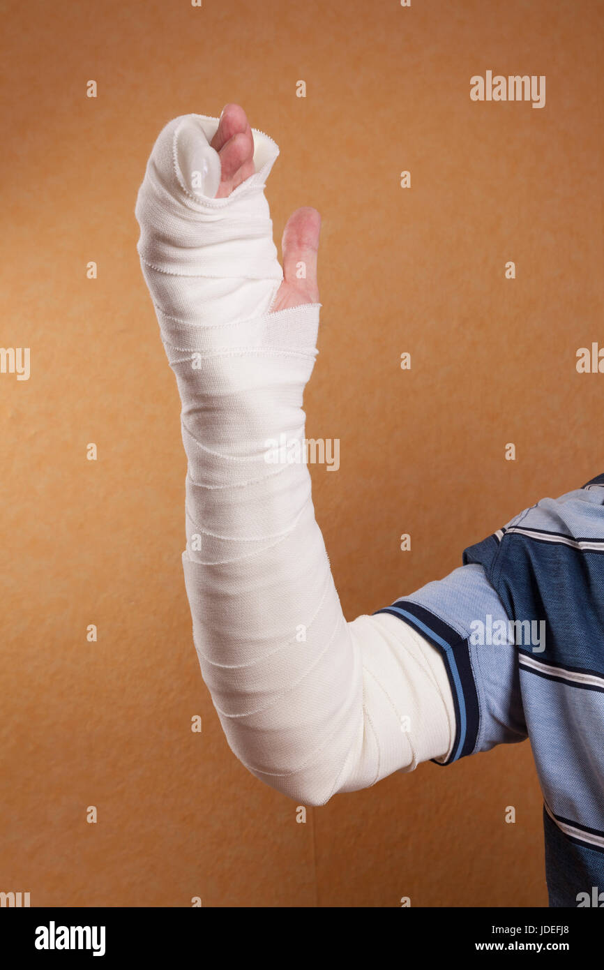 Gipsarm Fotos und Bildmaterial in hoher Auflösung Alamy