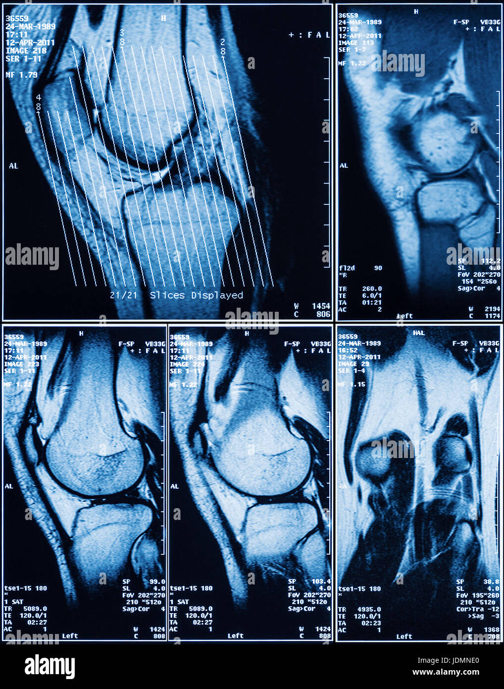 Menschlichen Knie MRT zur medizinischen Diagnostik Stockfoto