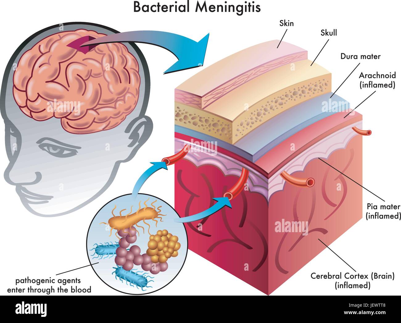 Gehirn, Meningitis, Schädel, Blut, Kopfschmerzen, Viren, Therapie, Fieber, Gehirn, Stock Vektor