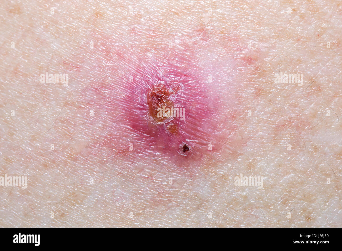 Das Basalzellkarzinom - präoperative Stockfoto