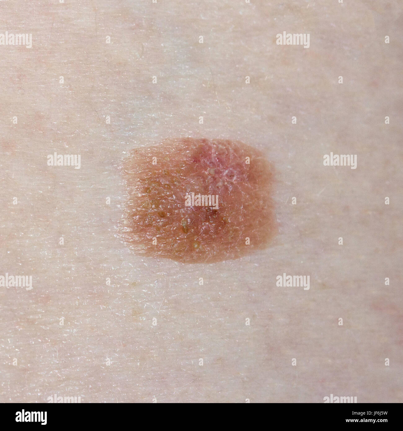 Maulwurf - Dermatologie Stockfoto