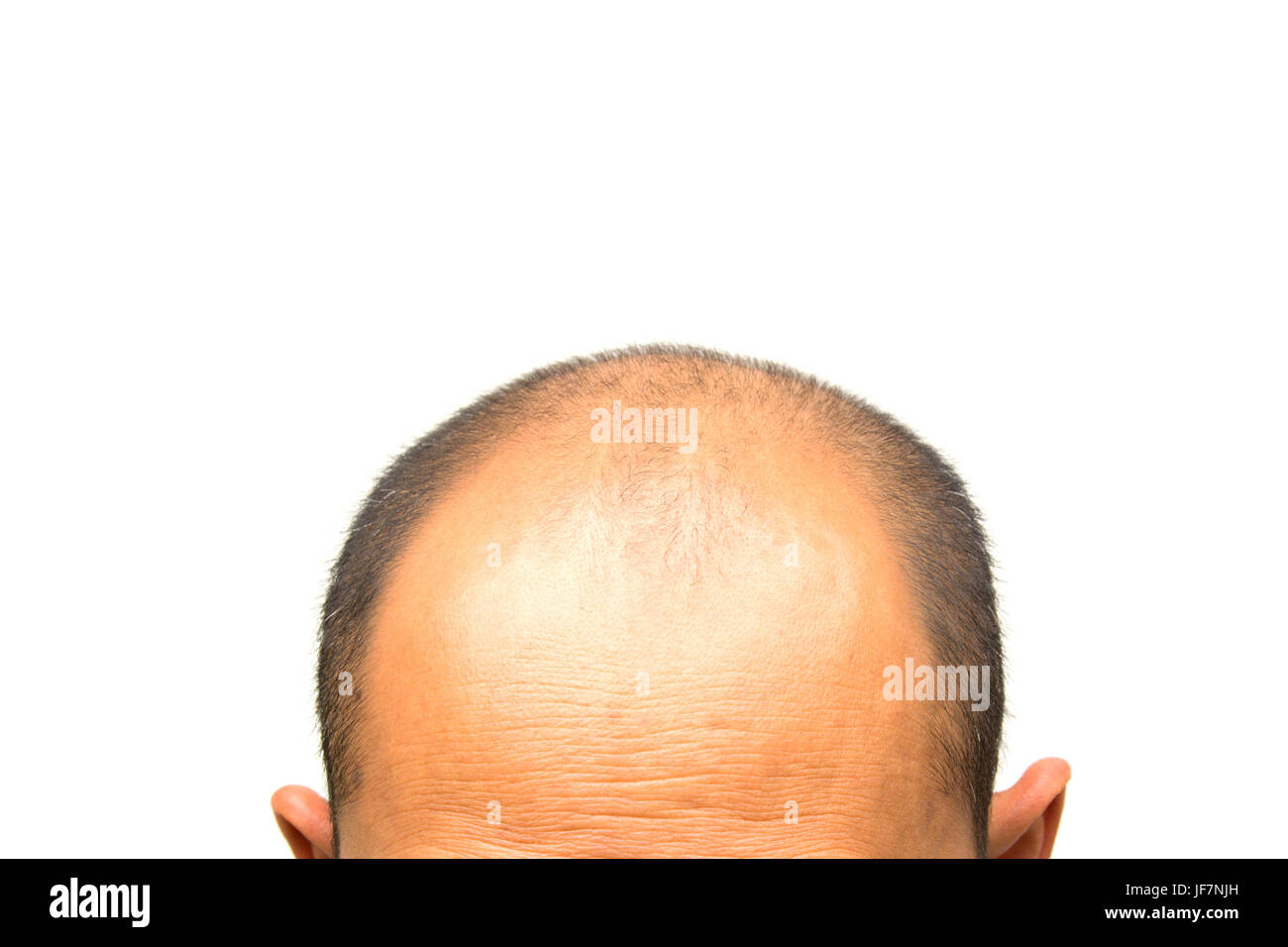 Kopf des Menschen verlieren die Haare, unbehaart auf seinem Kopf für ältere Menschen Stockfoto