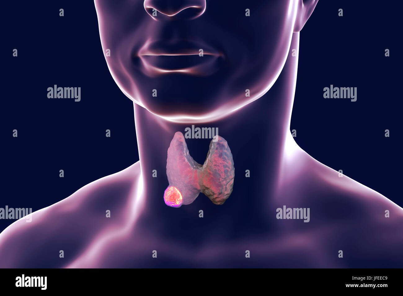 Thyroid Gland Tumour Fotos Und Bildmaterial In Hoher Aufl sung Alamy thyroid-gland-tumour-fotos-und-bildmaterial-in-hoher-aufl-sung-alamy