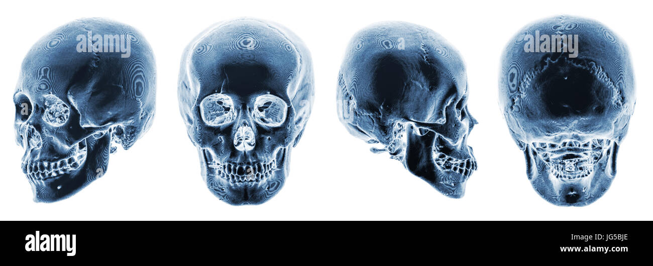 3D CT-Scan des menschlichen Schädels. Mehrere anzeigen. Farbstil zu invertieren. Stockfoto