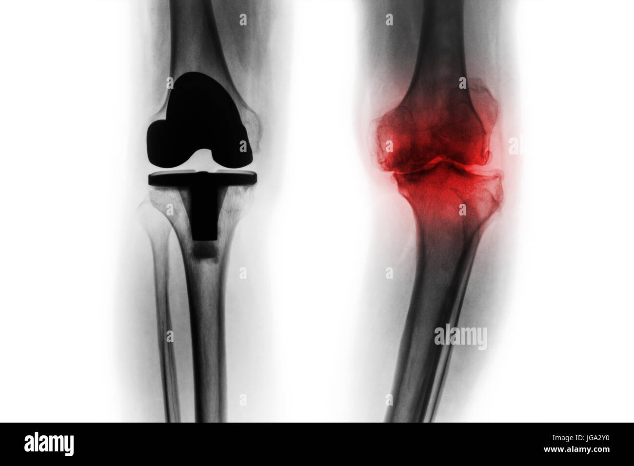 Roentgenfilm Arthrose Knie geduldig und künstlichen Gelenk (Knie-Totalprothese). Isolierte Hintergrund. Stockfoto
