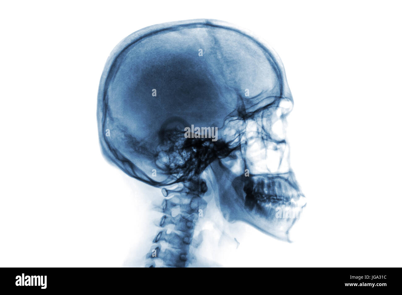 X-ray normal Schädel und Halswirbelsäule. Seitliche Ansicht. Farbstil zu invertieren. Stockfoto