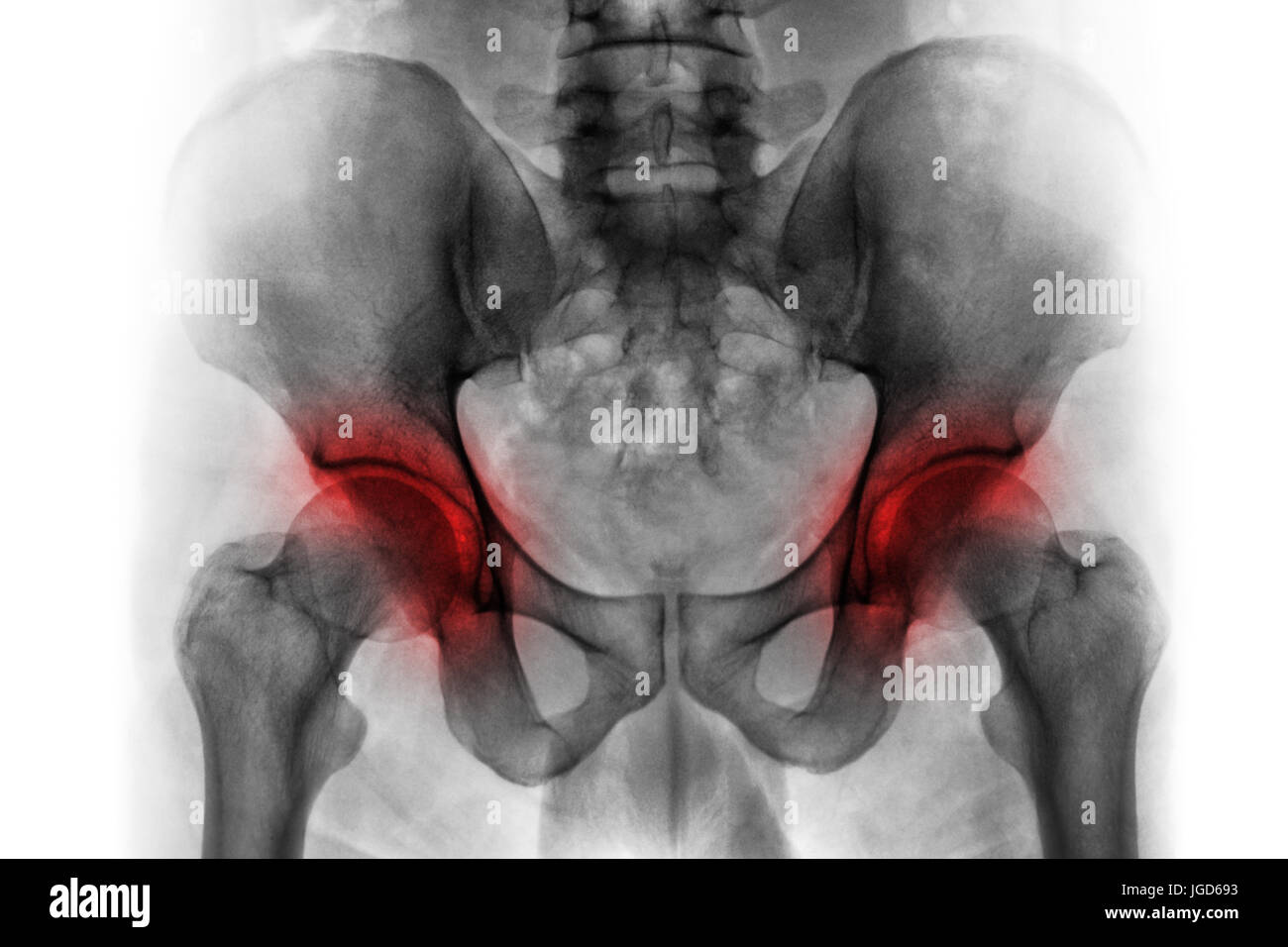 Arthritis, beide Hüfte. Der Roentgenfilm des menschlichen Beckens. Stockfoto