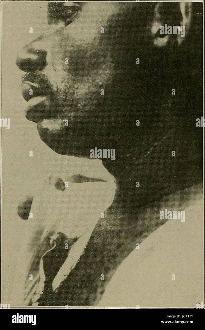 "Syphilis: eine Abhandlung über die Ätiologie, Pathologie, Diagnose, Prognose, Prophylaxe und Behandlung" (1921) Stockfoto
