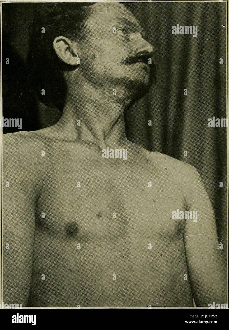 "Syphilis: eine Abhandlung über die Ätiologie, Pathologie, Diagnose, Prognose, Prophylaxe und Behandlung" (1921) Stockfoto