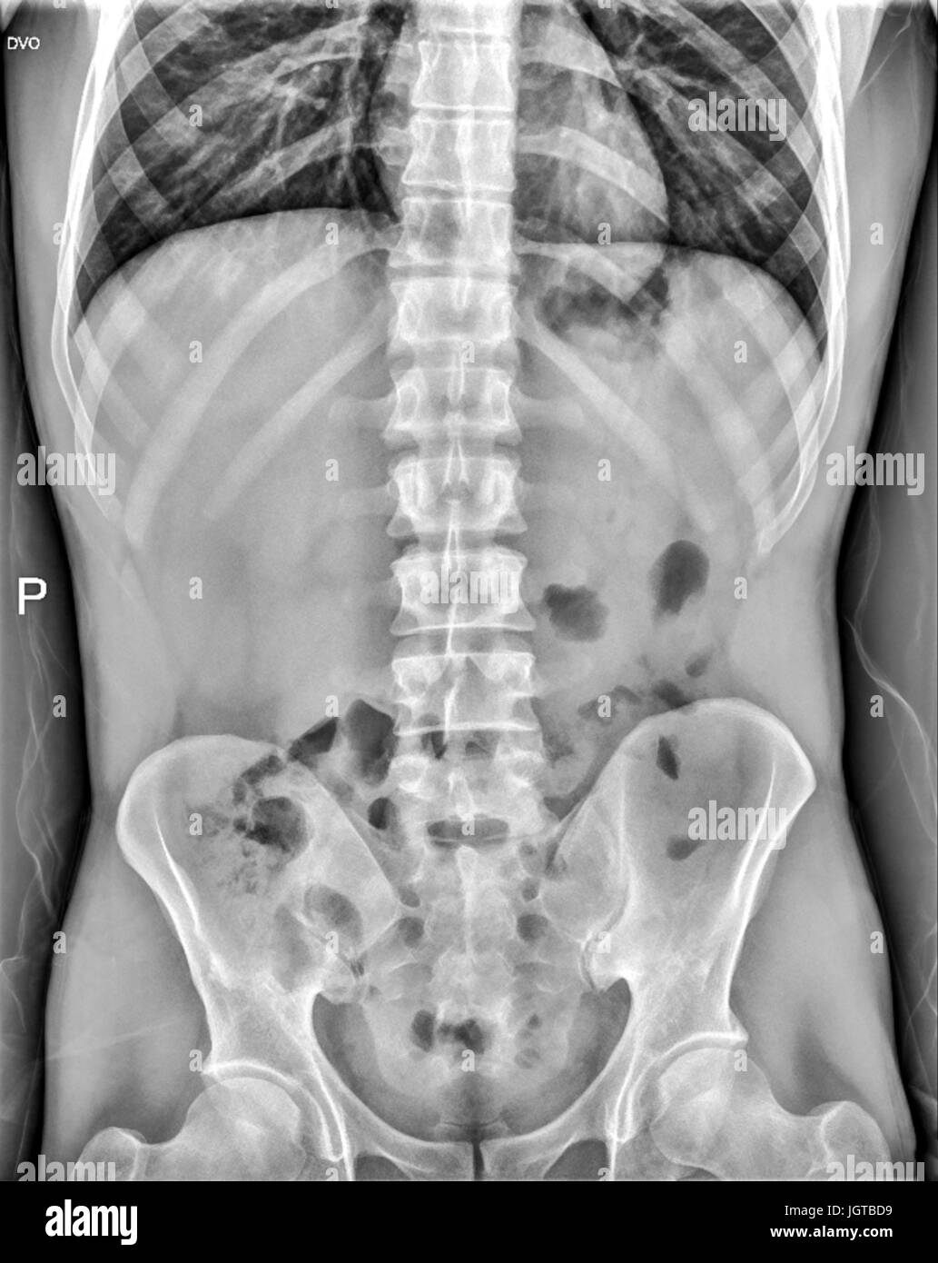 Abdomen medizinische Röntgen, Lunge, Herz, rig Cage, Hüftknochen, Rückenmark und inneren Organen. Stockfoto
