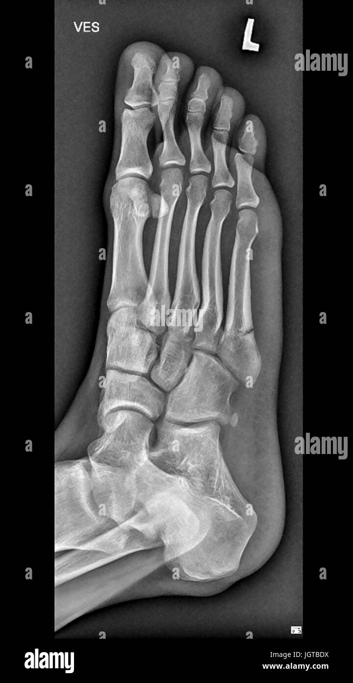 Fuß medizinische Xray, Knochenbruch, Behandlung von Patienten Stockfoto