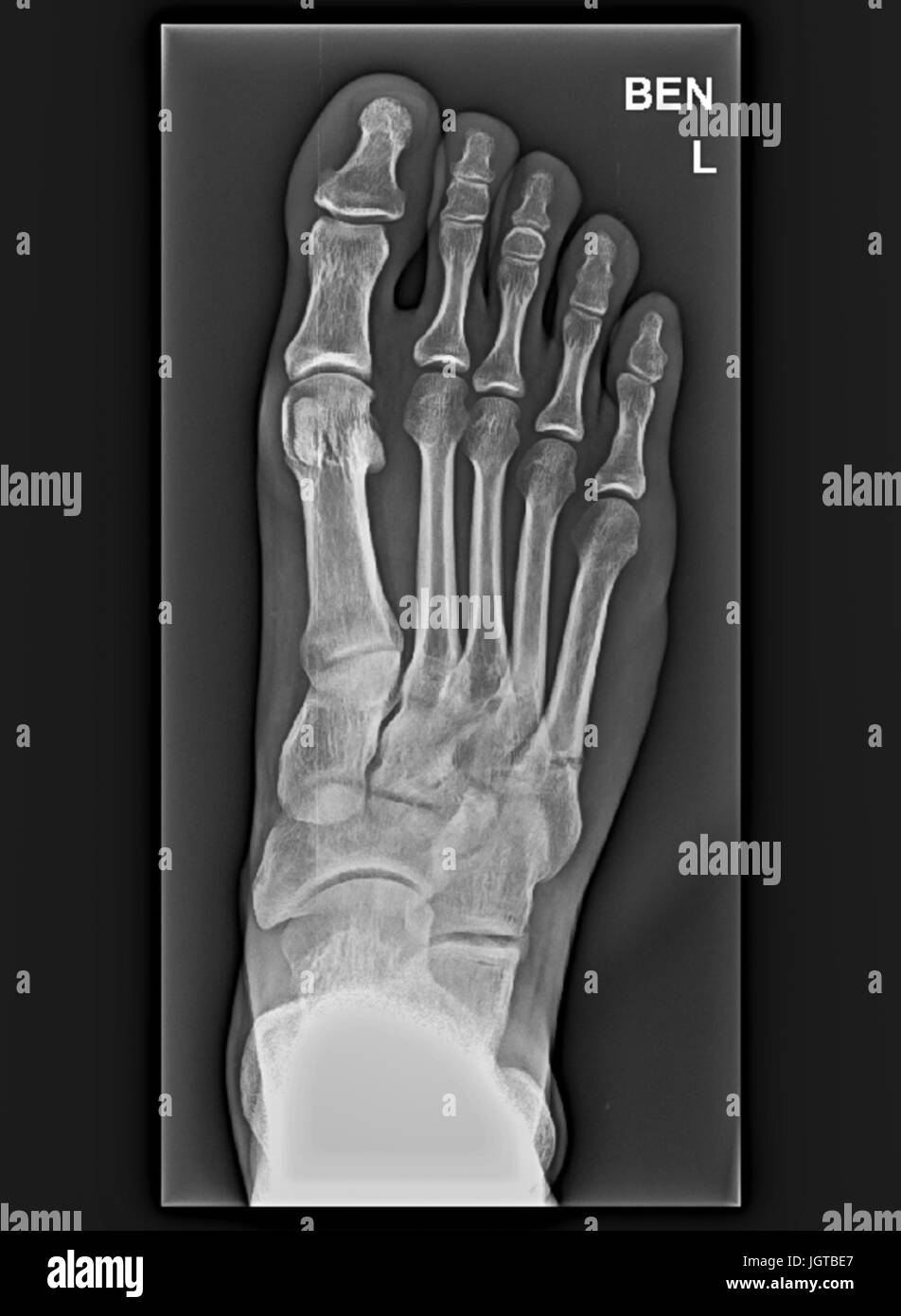 Fuß medizinische Xray, Knochenbruch, Behandlung von Patienten Stockfoto