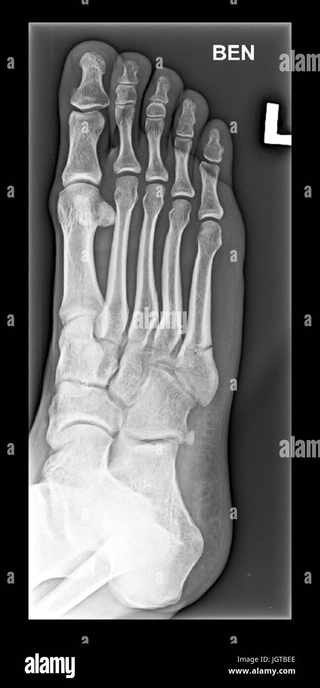 Fuß medizinische Xray, Knochenbruch, Behandlung von Patienten Stockfoto