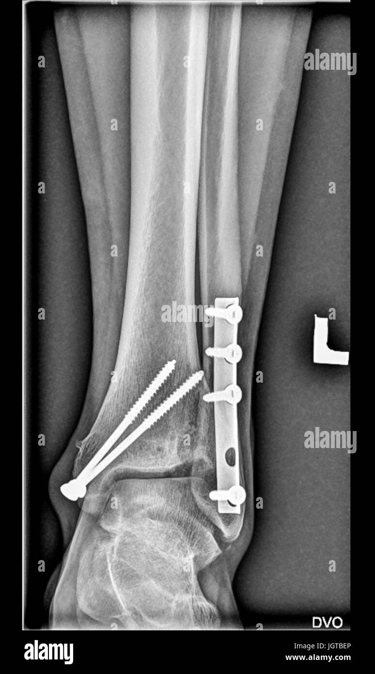 Fuß medizinische Röntgen, untere Extremität Knochen, gebrochenen Knöchel, Schienbein, Wadenbein mit Schrauben, Fingern Gelenke Stockfoto