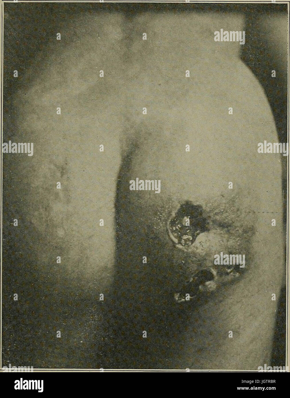 "Syphilis: eine Abhandlung über die Ätiologie, Pathologie, Diagnose, Prognose, Prophylaxe und Behandlung" (1921) Stockfoto