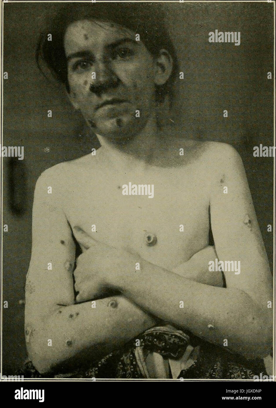 "Syphilis: eine Abhandlung über die Ätiologie, Pathologie, Diagnose, Prognose, Prophylaxe und Behandlung" (1921) Stockfoto