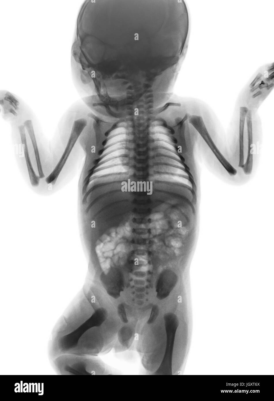 Film x-ray Ganzkörper normalen Säuglings. Ansicht von vorne. Stockfoto