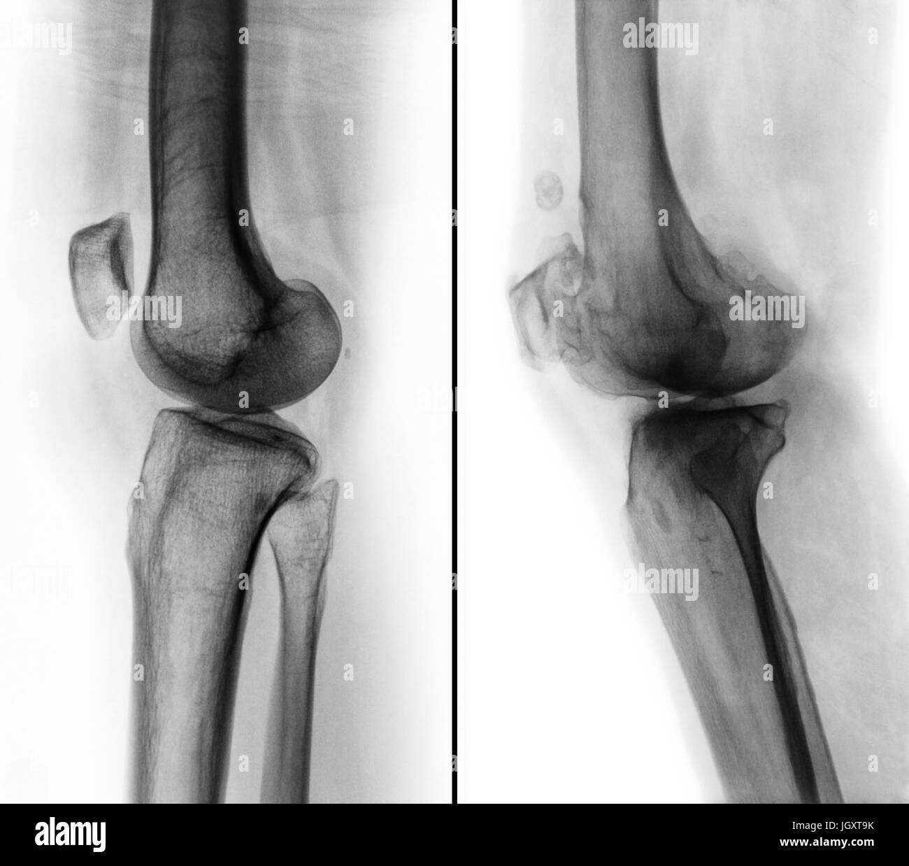 Vergleich zwischen normalen menschlichen Knie (linkes Bild) und Arthrose Knie (rechtes Bild). Seitliche Ansicht. Stockfoto
