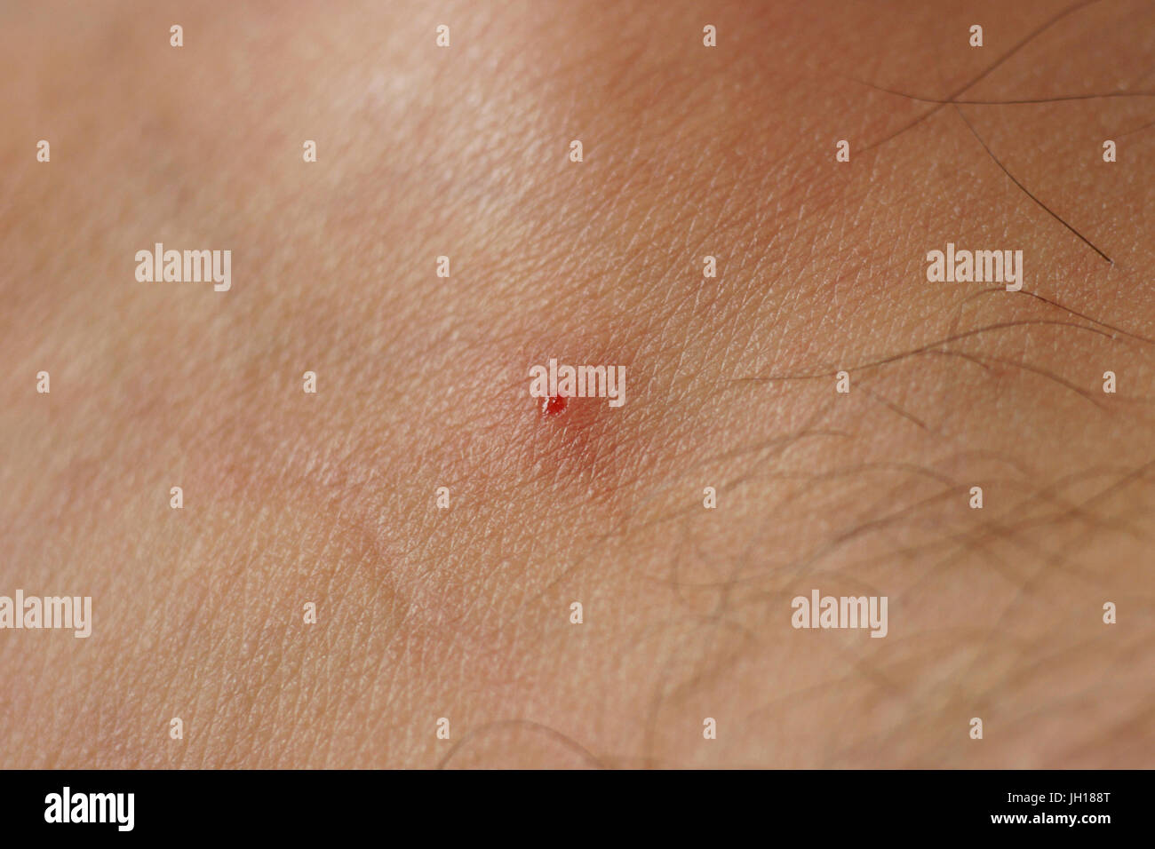 Schwarze Fliege Biss, Haut, Menschen, São Paulo, Brasilien Stockfotografie  - Alamy