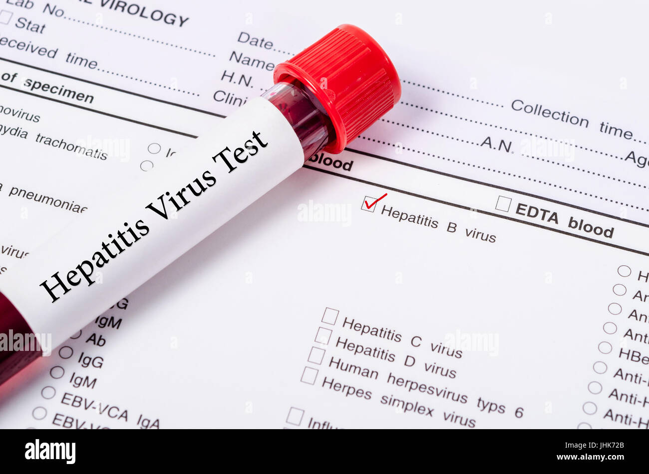 Blutprobe für Hepatitis B Virus (HBV) Testingl auf Anfrage-Formular-Screening-Test. Stockfoto