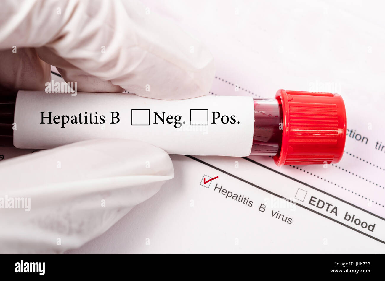 Hand mit Blut Rohr für Hepatitis-Tests im Labor. Stockfoto