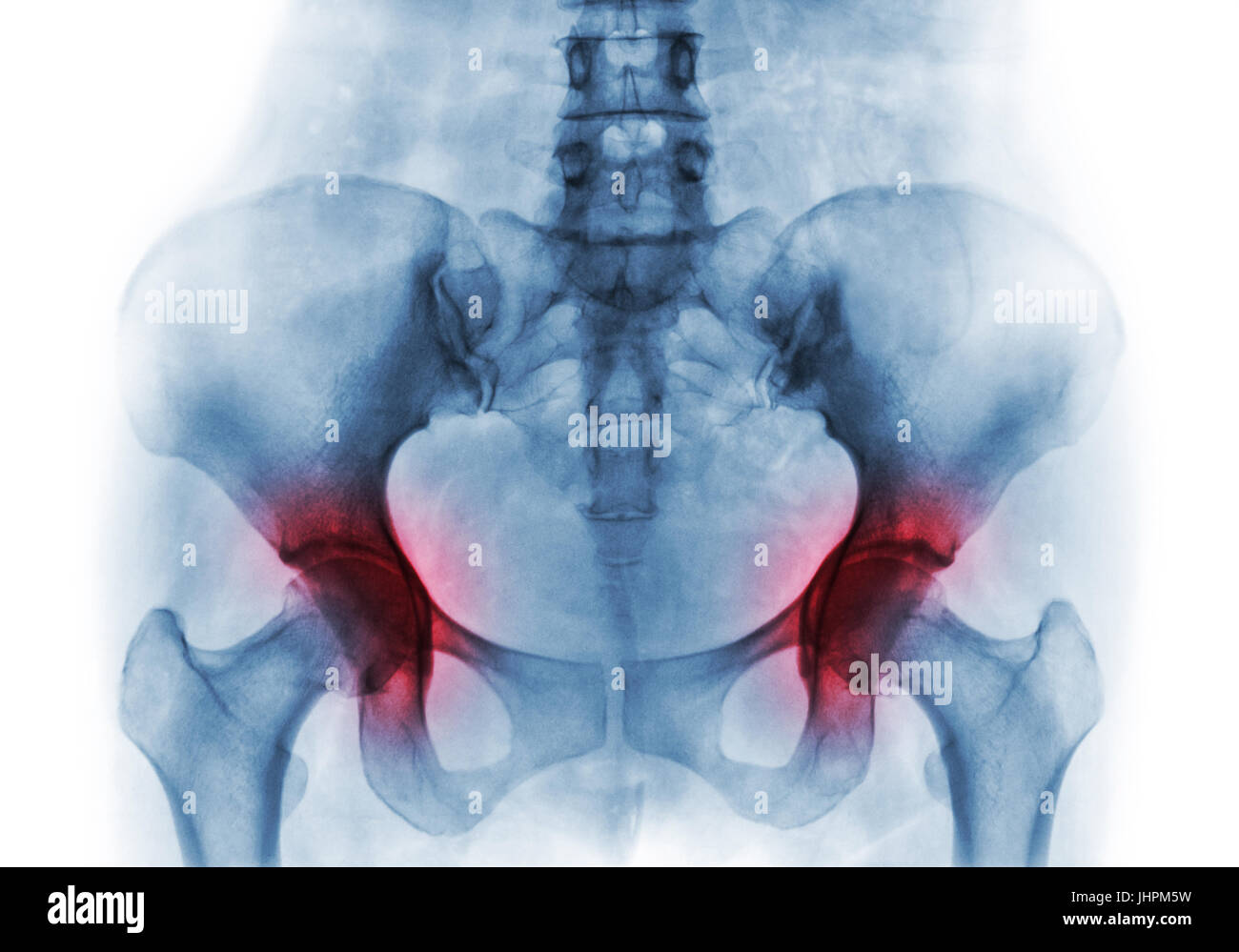 Radiografia de cadera y pelvis humano -Fotos und -Bildmaterial in hoher ...