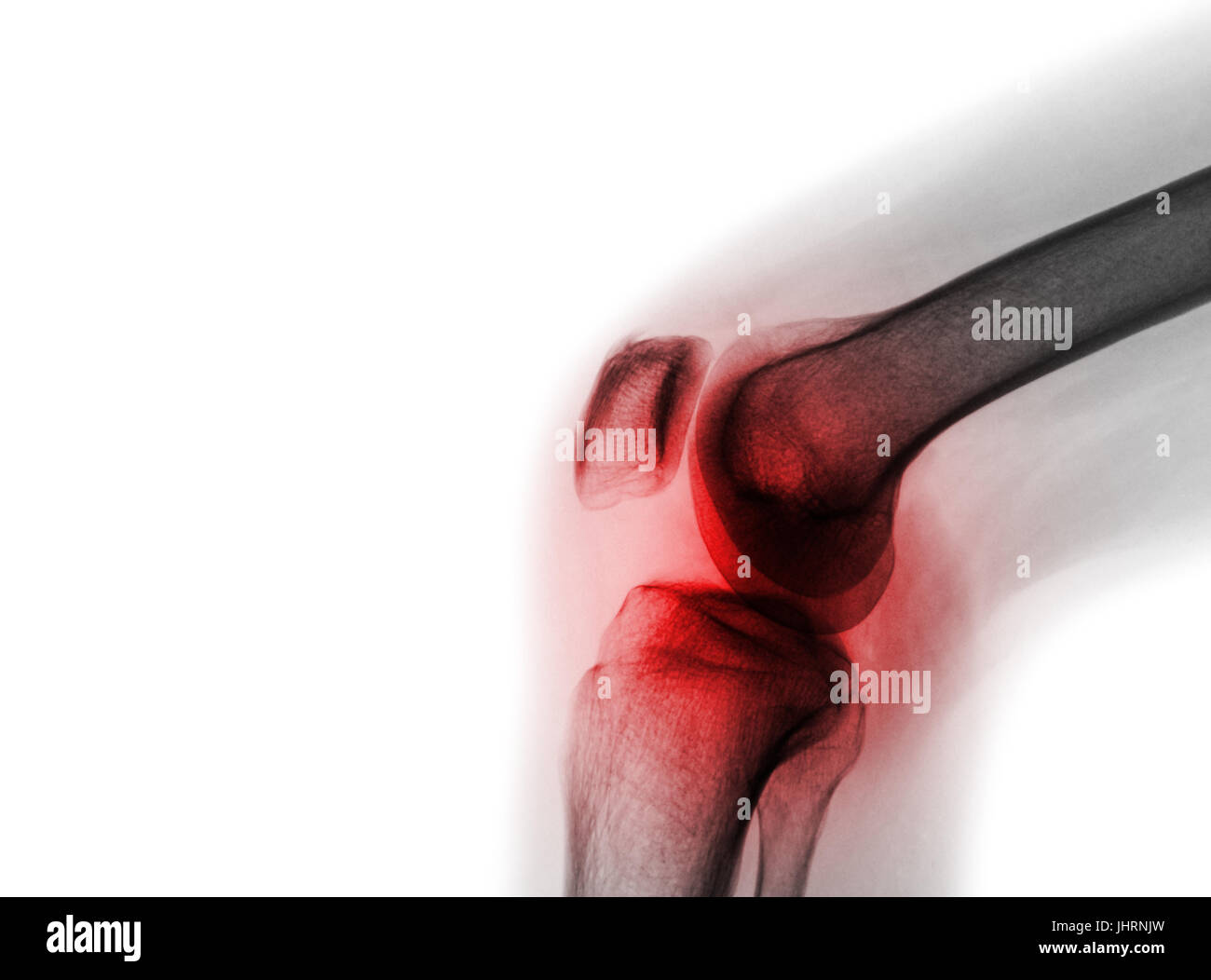 Film x-ray Kniegelenk bei Arthritis (Gicht, rheumatoide Arthritis, septische Arthritis, Arthrose Knie) und leeren Bereich auf der linken Seite Stockfoto