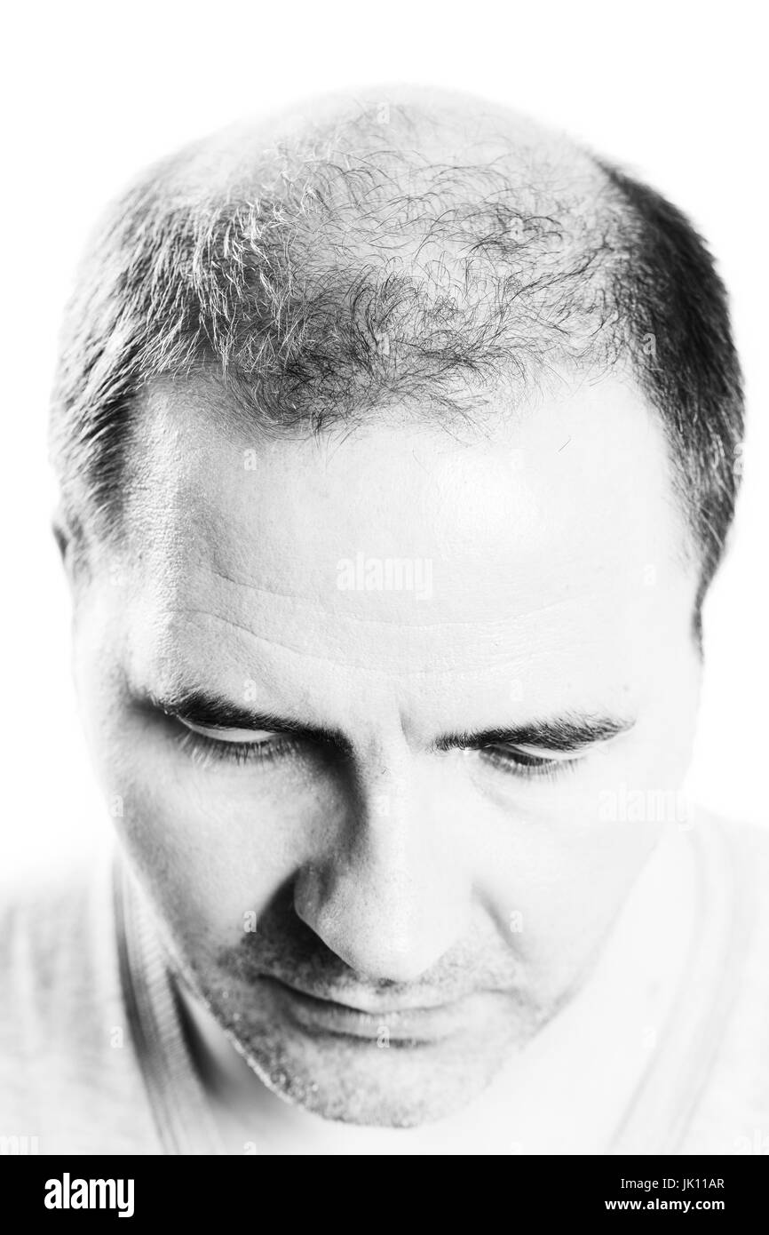 Mann mittleren Alters betroffen Haar Verlust Glatze Haarausfall Alopezie schwarz / weiß Stockfoto
