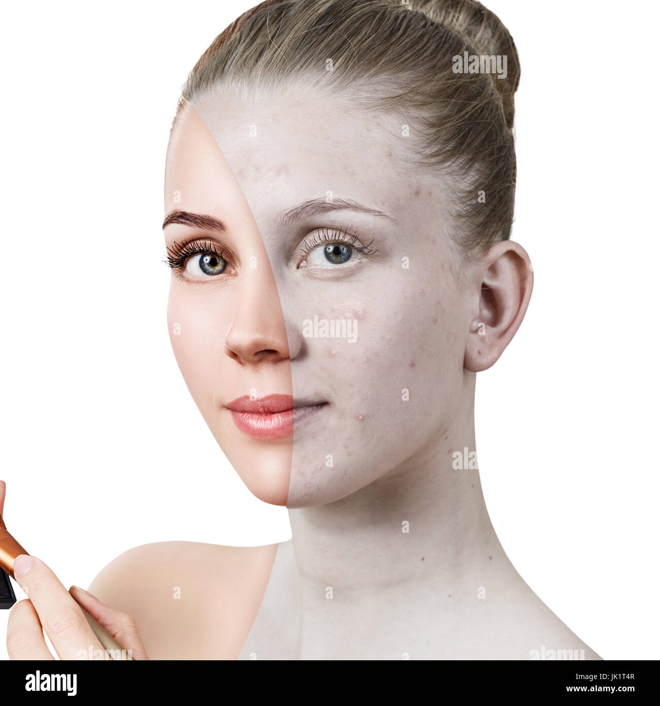 Junge Frau mit Akne vor und nach der Behandlung. Stockfoto