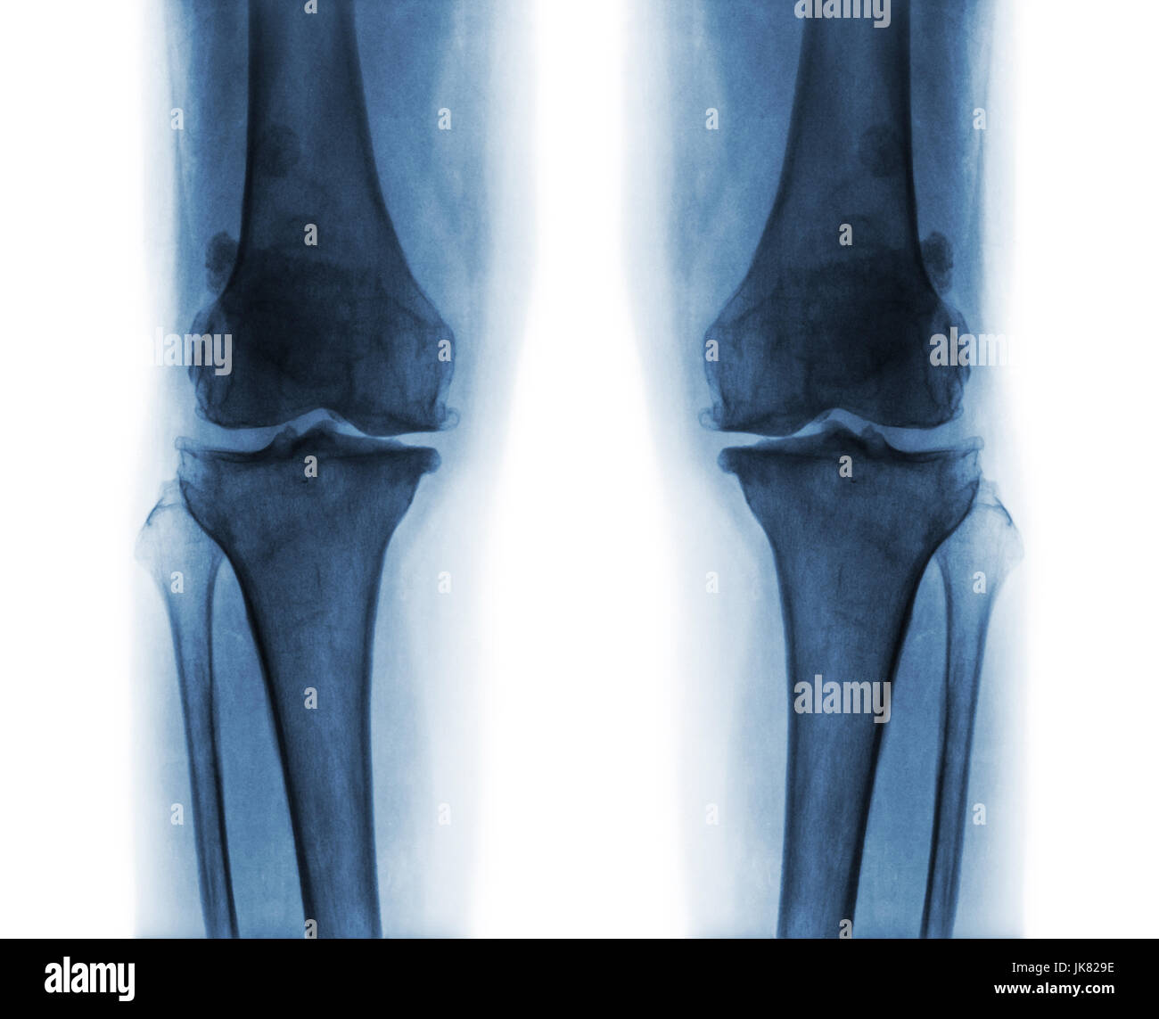Arthrose, die beide Knie.  Film x-ray AP (anterior - posterior) Knie Show schmale Gelenkspalt. Osteophyten (Spur). Subcondral Sklerose. Stockfoto