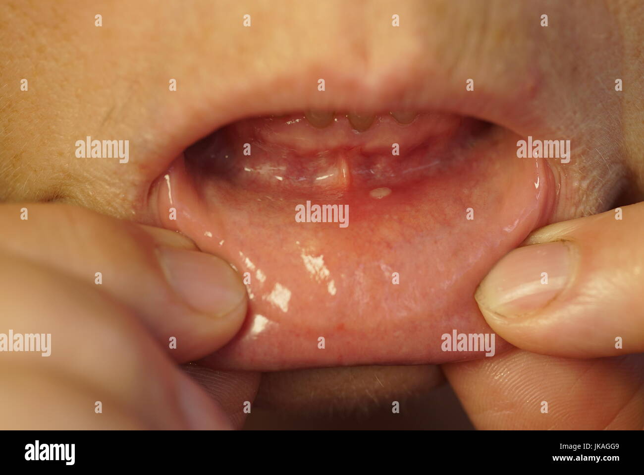 Stomatitis in Mund an der Unterlippe. Close-up Stockfoto