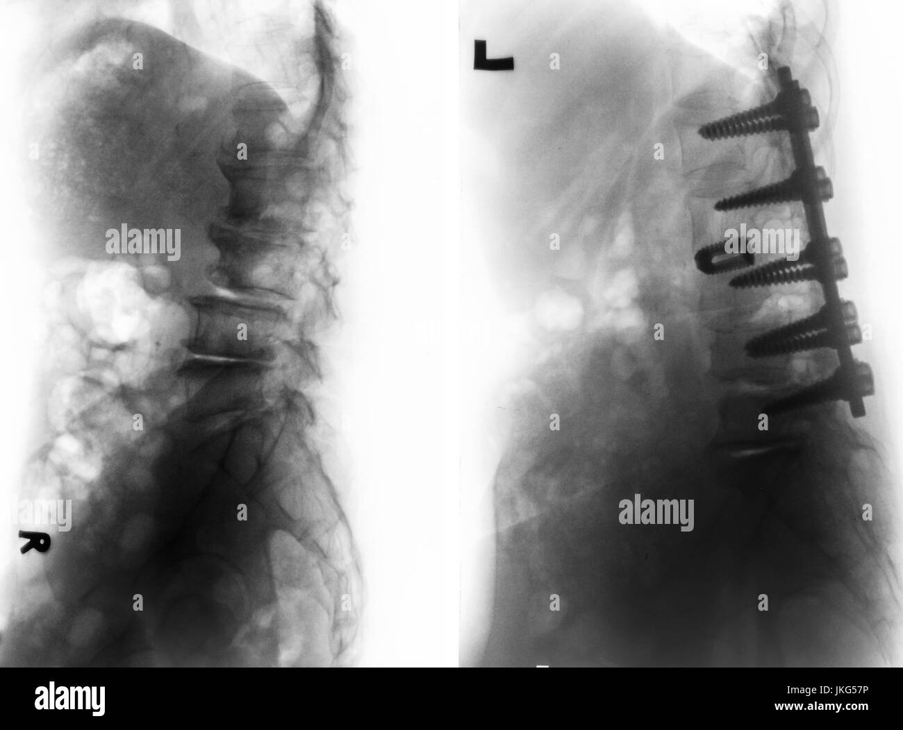 Spondylose. Der Roentgenfilm Lendenwirbelsäule und Vergleich zwischen vor der Operation (linkes Bild) und nach der Operation (rechtes Bild). Patient wurde operiert Stockfoto