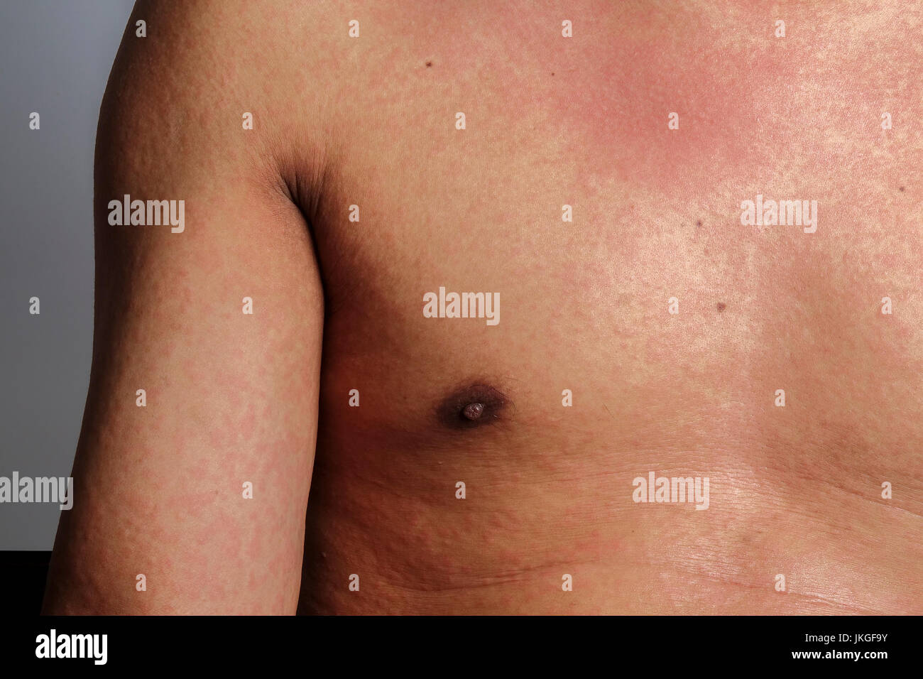Mann mit Dermatitis Problem der Ausschlag, Allergie Hautausschlag Stockfoto