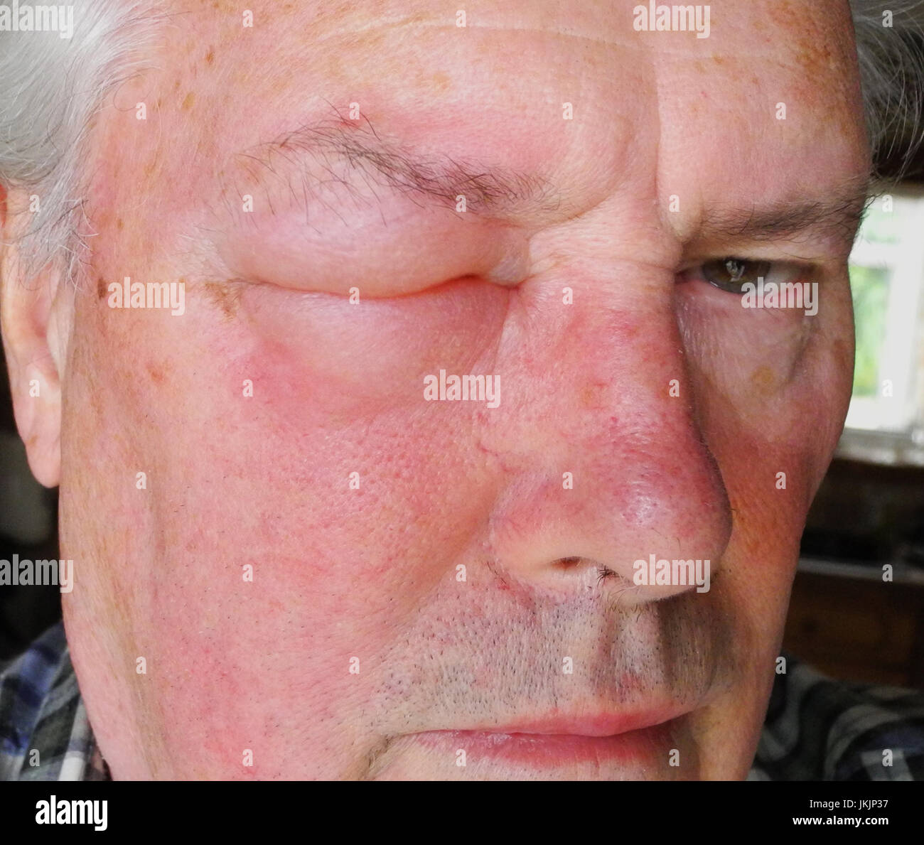 Hautausschlag Allergie