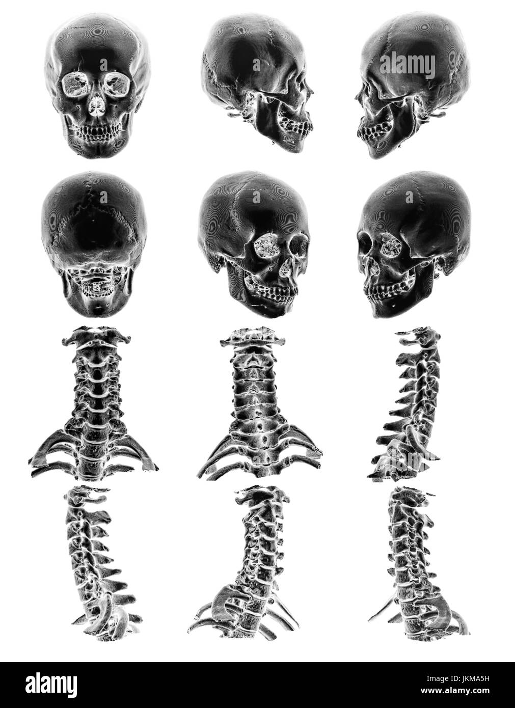 CT-Scan (Computertomographie-Tomographie) mit 3D Grafik zeigen normale menschliche Schädel und Halswirbelsäule. Mehrere anzeigen. Stockfoto