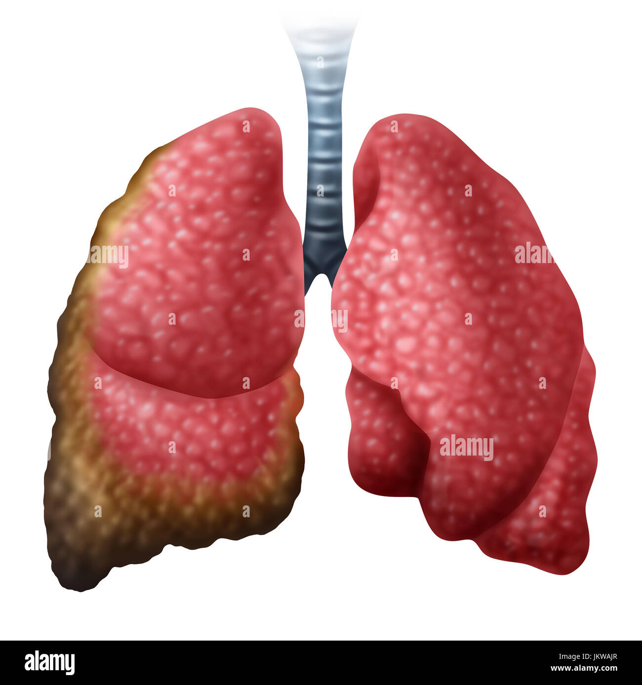 Mesotheliom Krebs Krankheitskonzept als menschliche Lunge mit wachsender maligner Krebszellen als medizinische Krankheit konzeptionelle Symbol. Stockfoto
