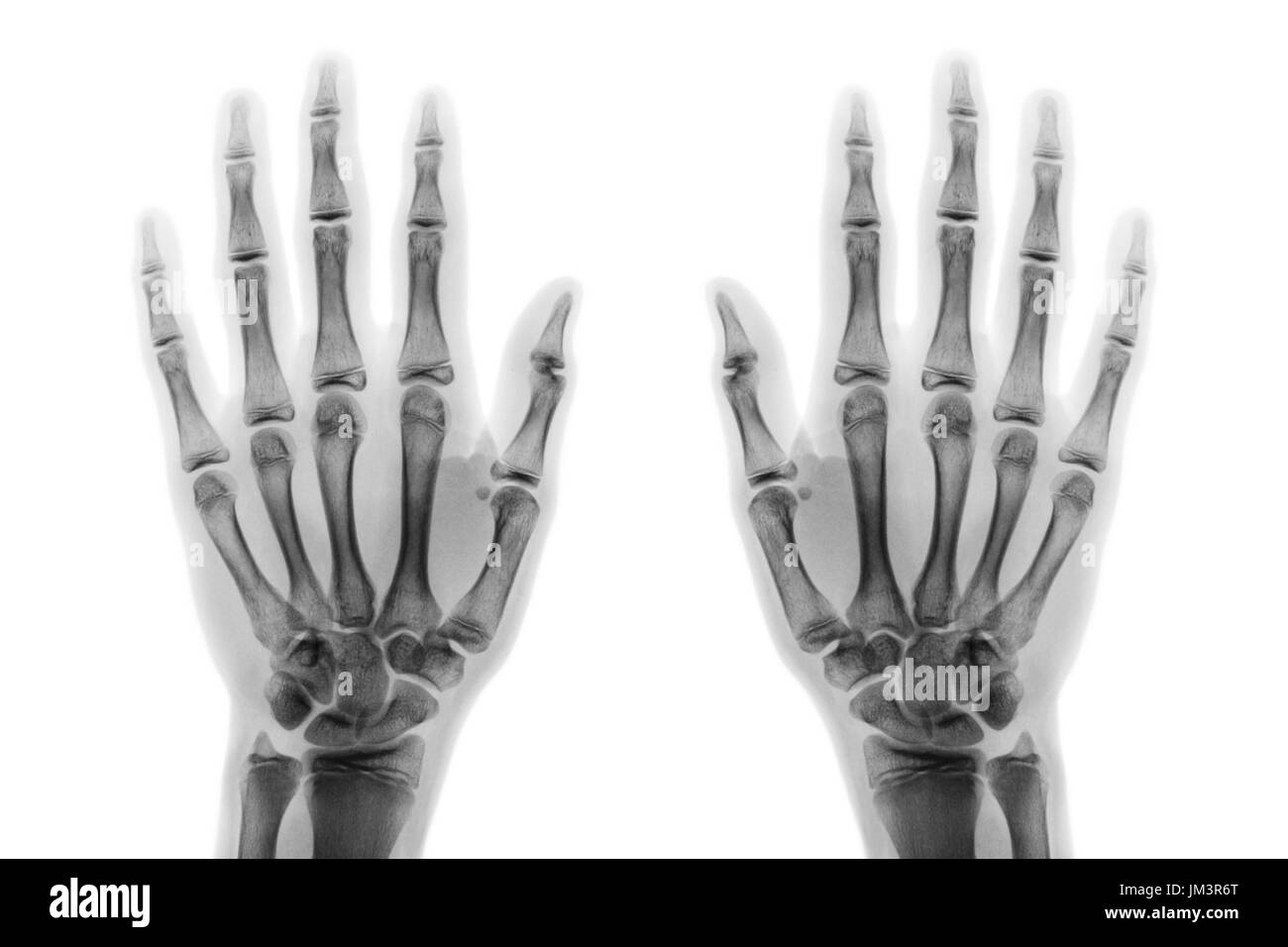 Sowohl der Roentgenfilm hand AP zeigen normale menschliche Hände auf weißem Hintergrund (isoliert). Stockfoto