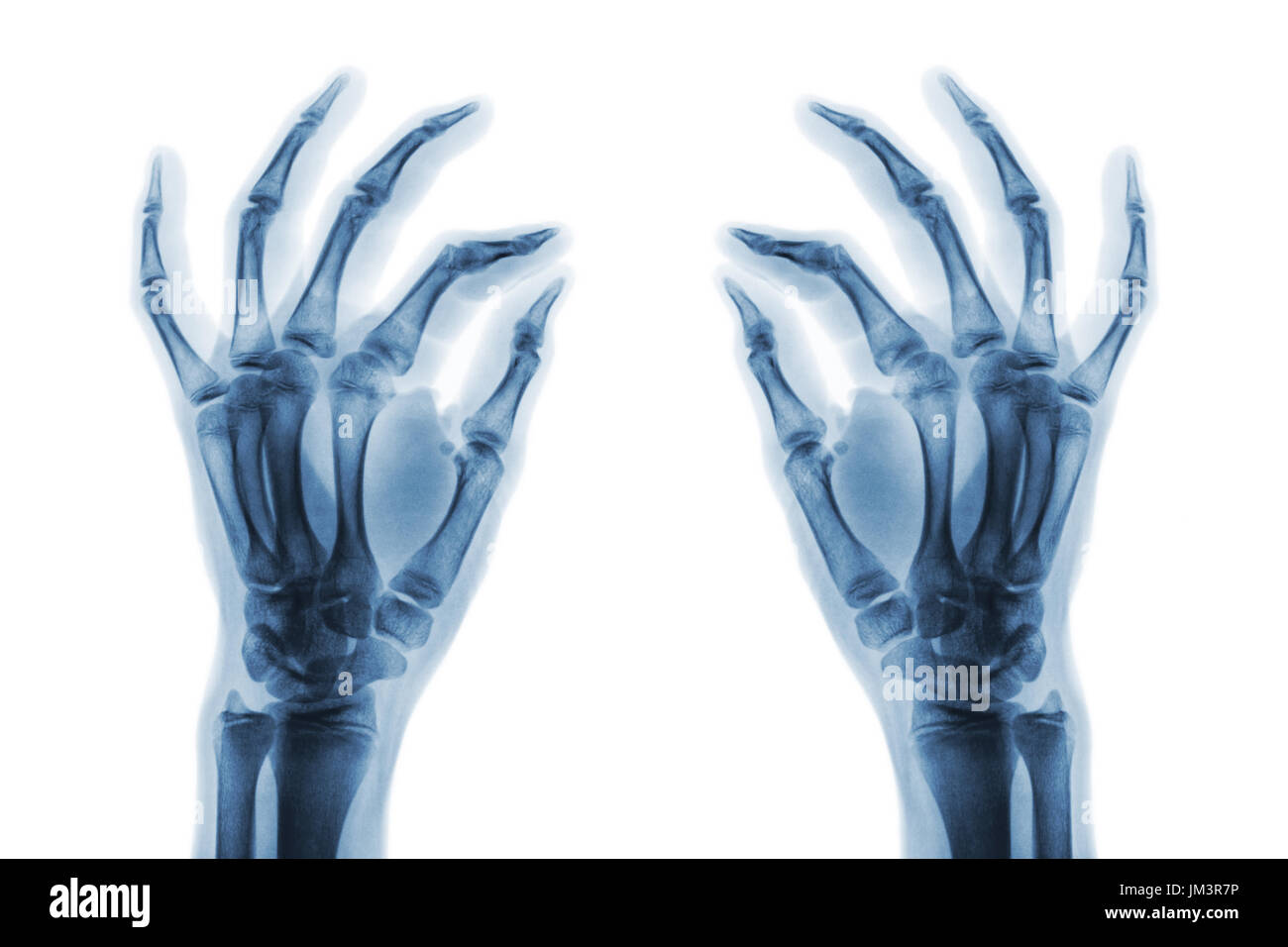 X-ray normale menschliche Hände auf weißem Hintergrund. Schrägansicht. Stockfoto