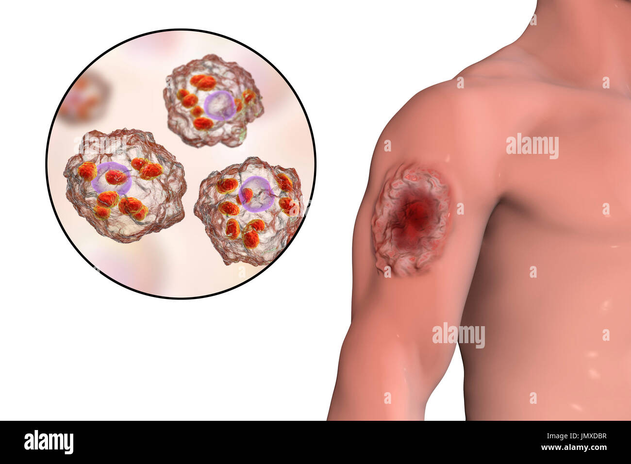 Haut-Geschwür in kutane Leishmaniose und Nahaufnahme von Leishmaniose Amastigoten in Makrophagen, Abbildung gefunden. Dieser Zustand der Haut wird durch eine Infektion durch Protozoen Leishmania-Parasiten verursacht. Sie sind auf den Menschen durch den Biss eines infizierten Sandfly übertragen. Kutane (Haut) Form ist die häufigste. Die Läsionen heilen in der Regel, obwohl Narbenbildung möglich ist. Die Behandlung ist durch Drogen oder Kryotherapie. Leishmania-Parasiten sind weltweit in subtropischen und tropischen Regionen gefunden. Stockfoto