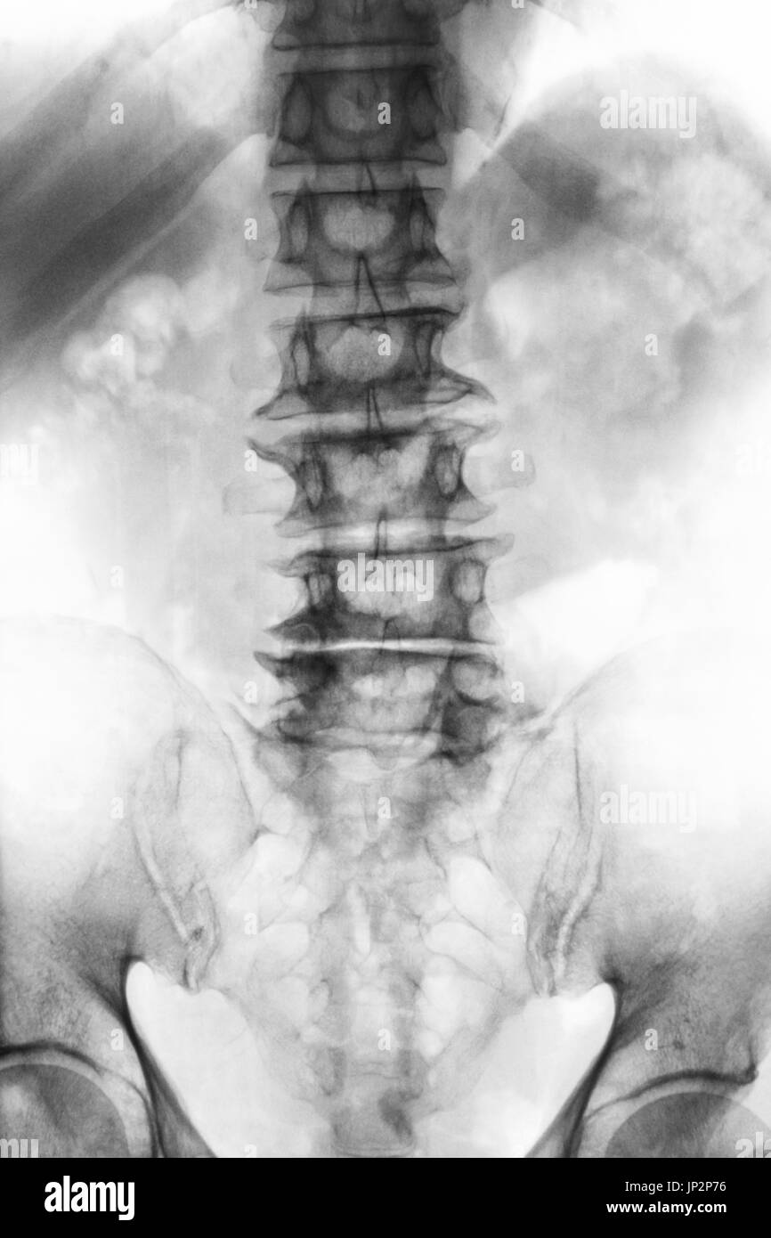 Spondylose.  Film x-ray lumbosakralen Wirbelsäule im Alter von alten Patienten zeigen Osteophyten, Zusammenbruch Wirbelsäule von degenerativen Prozess. Ansicht von vorne. Stockfoto