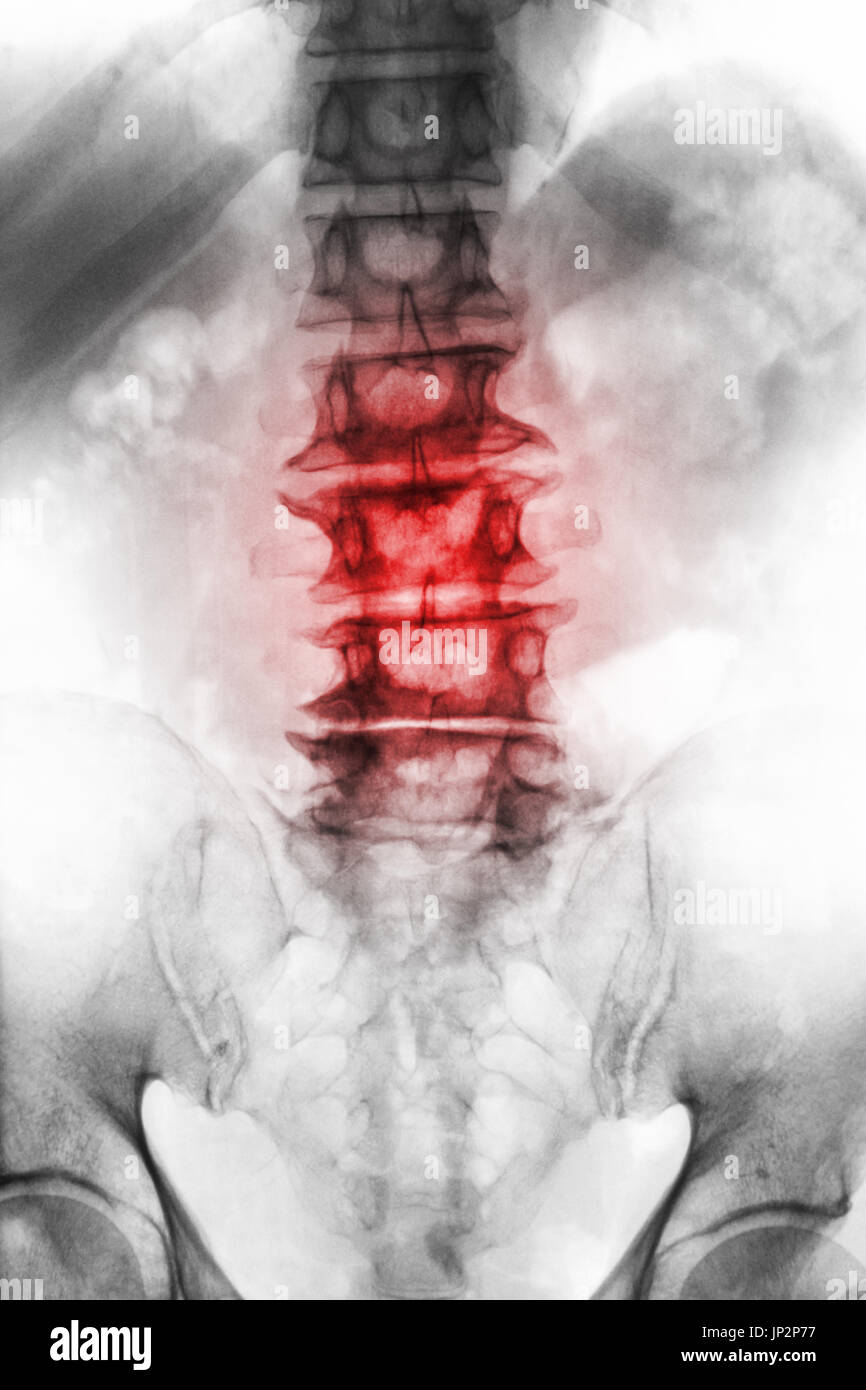 Spondylose.  Film x-ray lumbosakralen Wirbelsäule im Alter von alten Patienten zeigen Osteophyten, Zusammenbruch Wirbelsäule von degenerativen Prozess. Ansicht von vorne. Stockfoto