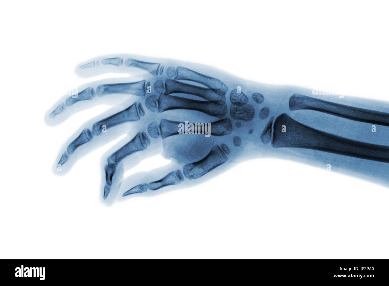 Film x-ray Hand des Kindes. Schrägansicht. Stockfoto