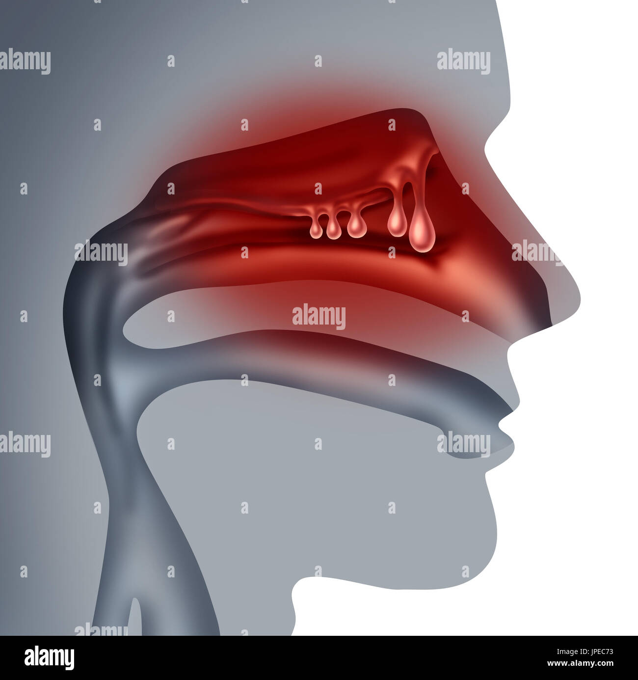 Nasal polyps illustration -Fotos und -Bildmaterial in hoher Auflösung ...