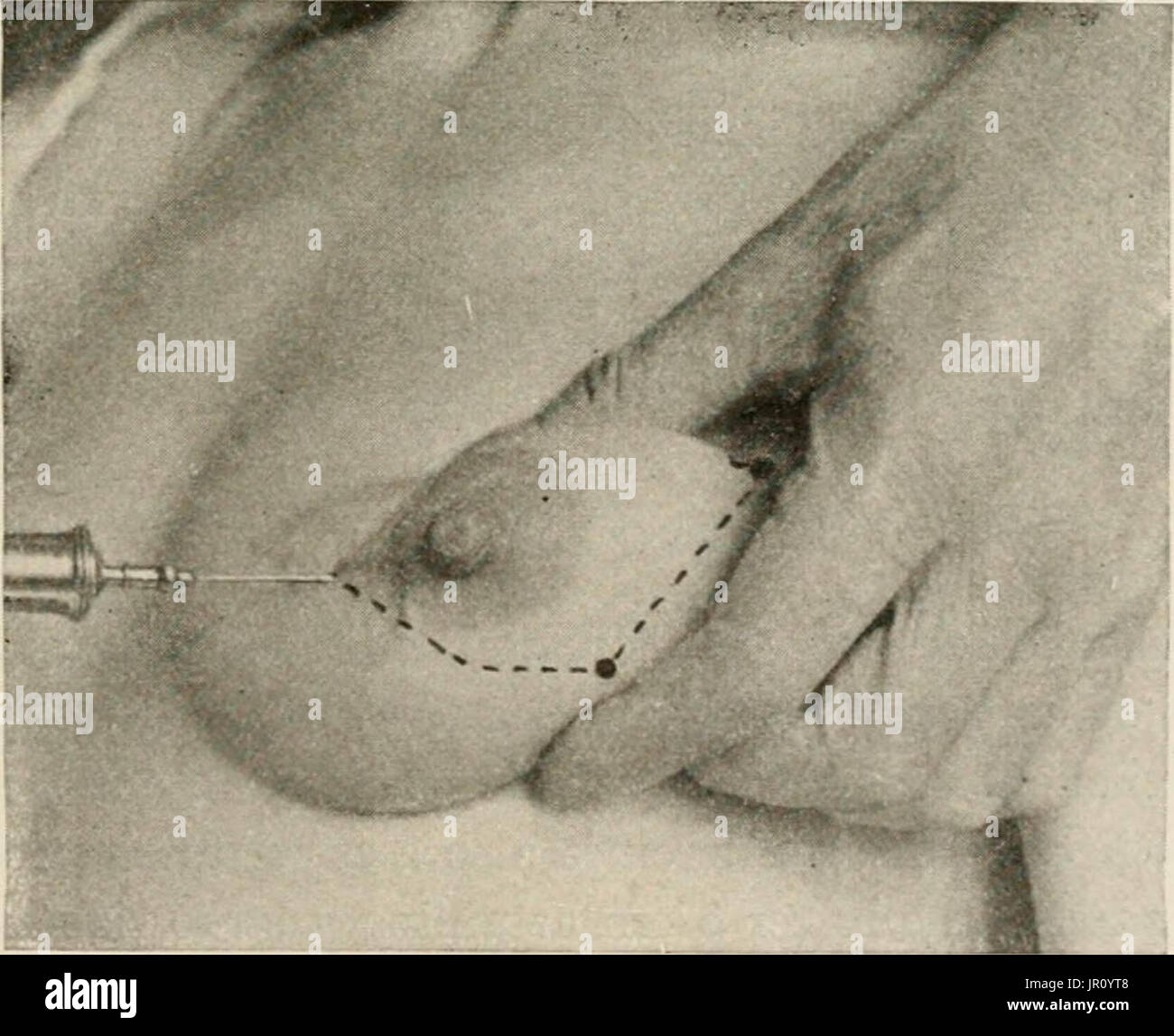 "Lokale und regionale Anästhesie; mit Kapiteln über spinale, epidurale, paravertebralen und Parasacral Analgesie und andere Anwendungen der lokalen und regionalen Anästhesie die Operation der Augen, Ohren, Nase und Rachen und Zahnarztpraxis " Stockfoto