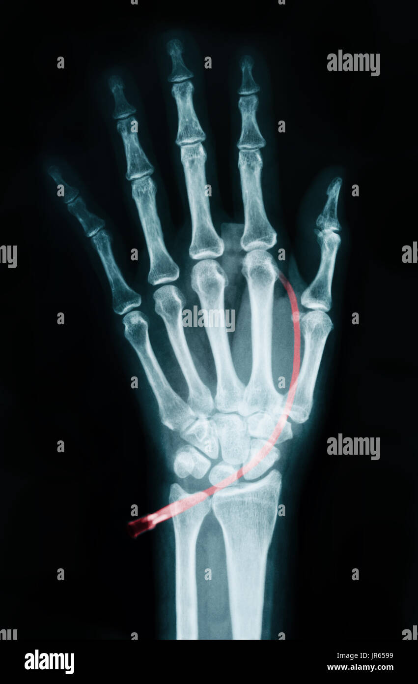 Die linke Hand auf Gerät x-ray - Medical Image Stockfoto